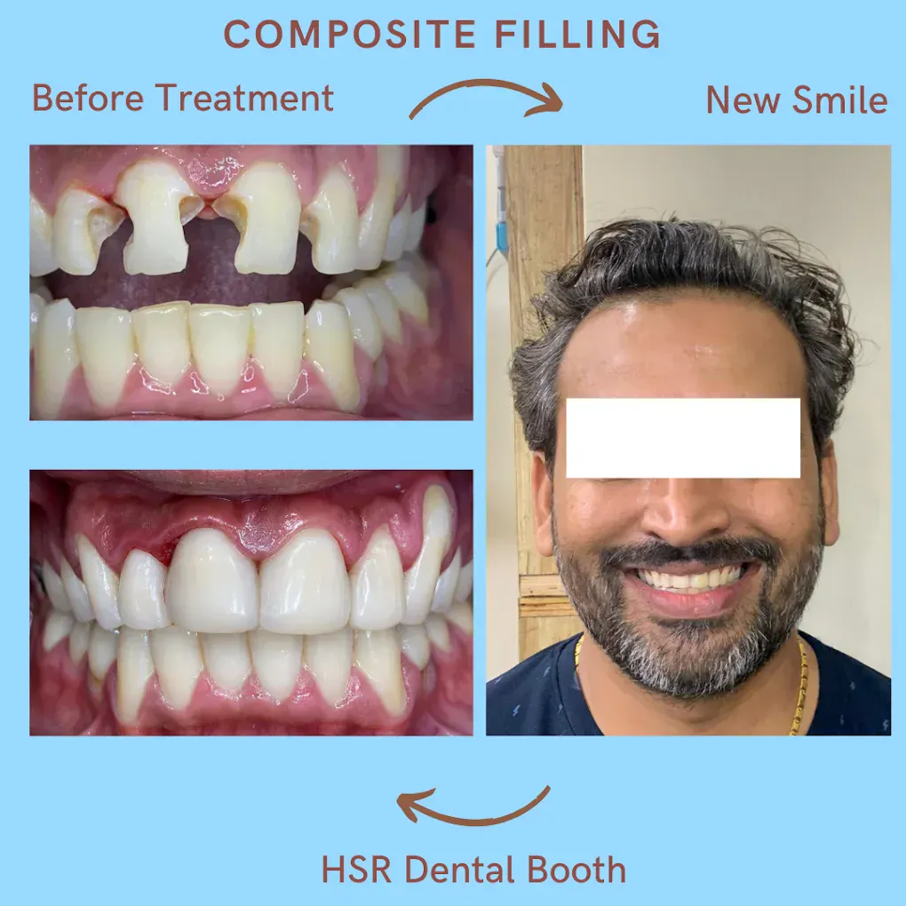 Composite filling before and after at HSR Dental Booth