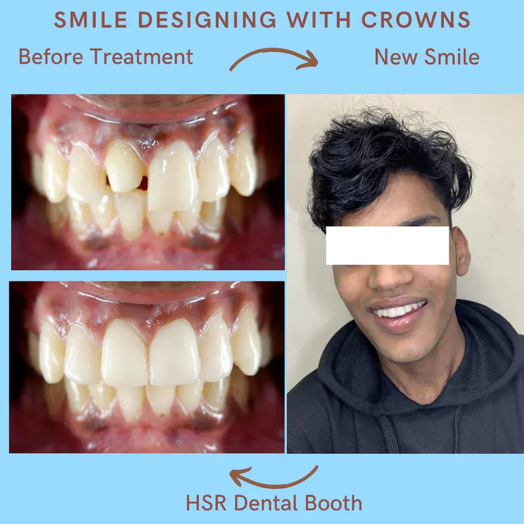 Smile designing with dental crowns before and after at HSR Dental Booth
