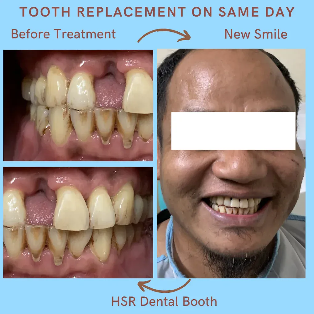 Same-day tooth replacement and denture result at HSR Dental Booth, HSR Layout Bengaluru