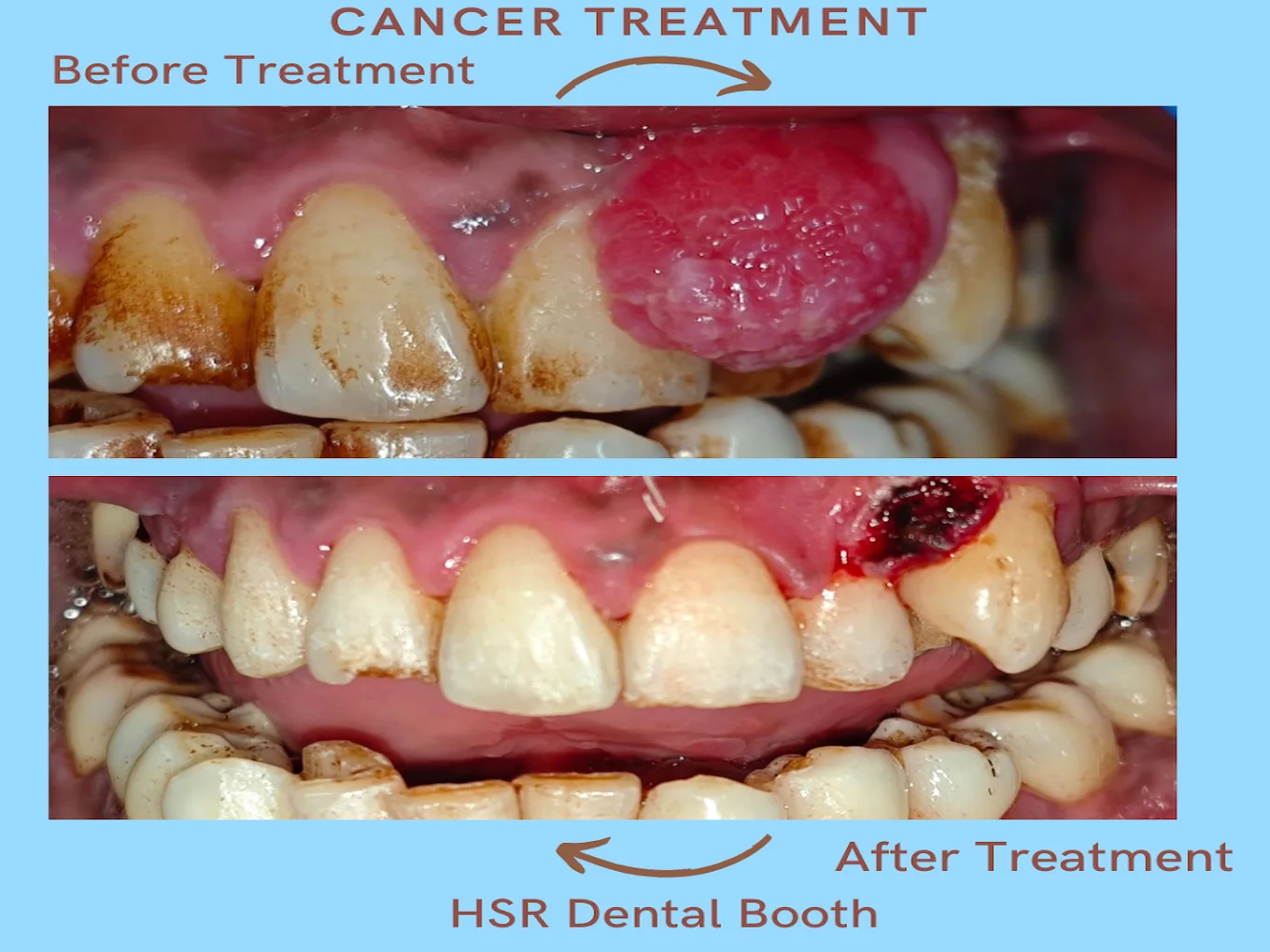Gum treatment before and after case at HSR Dental Booth, HSR Layout Bengaluru