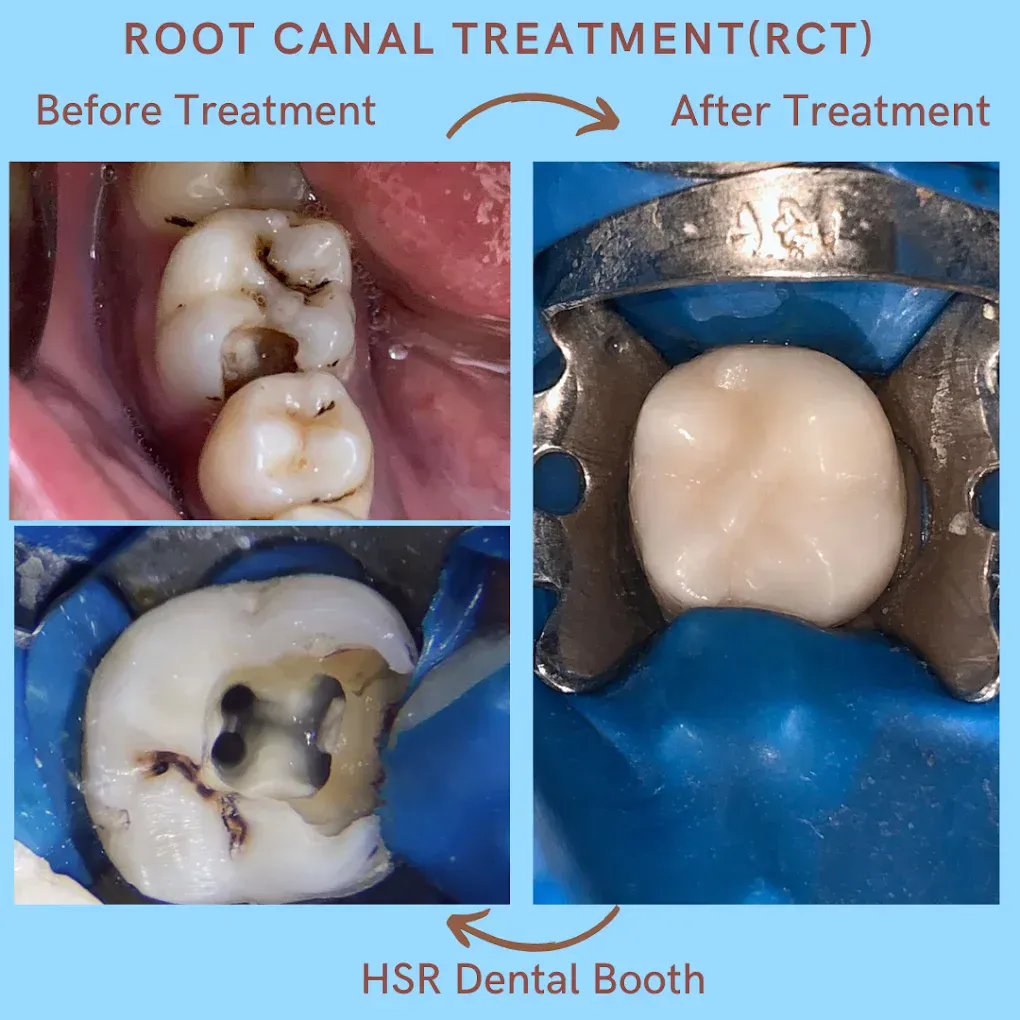 Root canal treatment clinical before and after at HSR Dental Booth