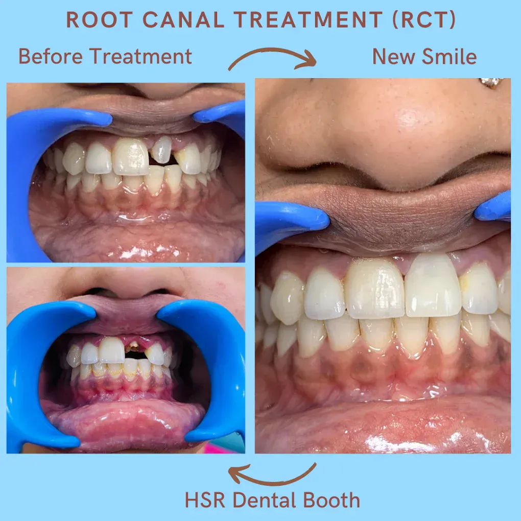 Root canal treatment and crown restoration before and after at HSR Dental Booth