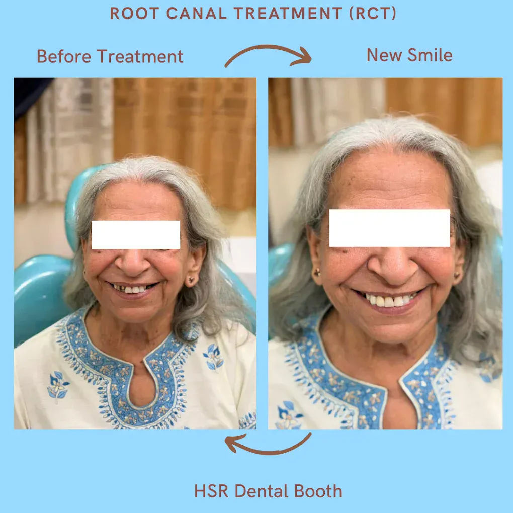 Root canal treatment patient smile before and after at HSR Dental Booth