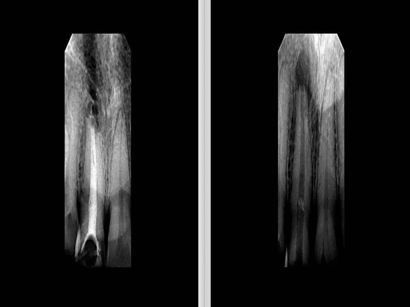 Root canal x-ray before and after at HSR Dental Booth, HSR Layout Bengaluru