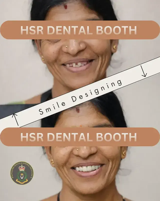 Smile designing with dental veneers at HSR Dental Booth, HSR Layout Bengaluru