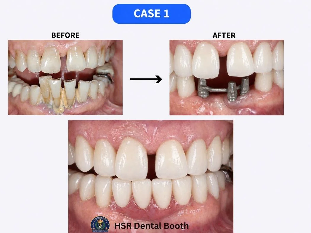 Dental implant before and after case at HSR Dental Booth