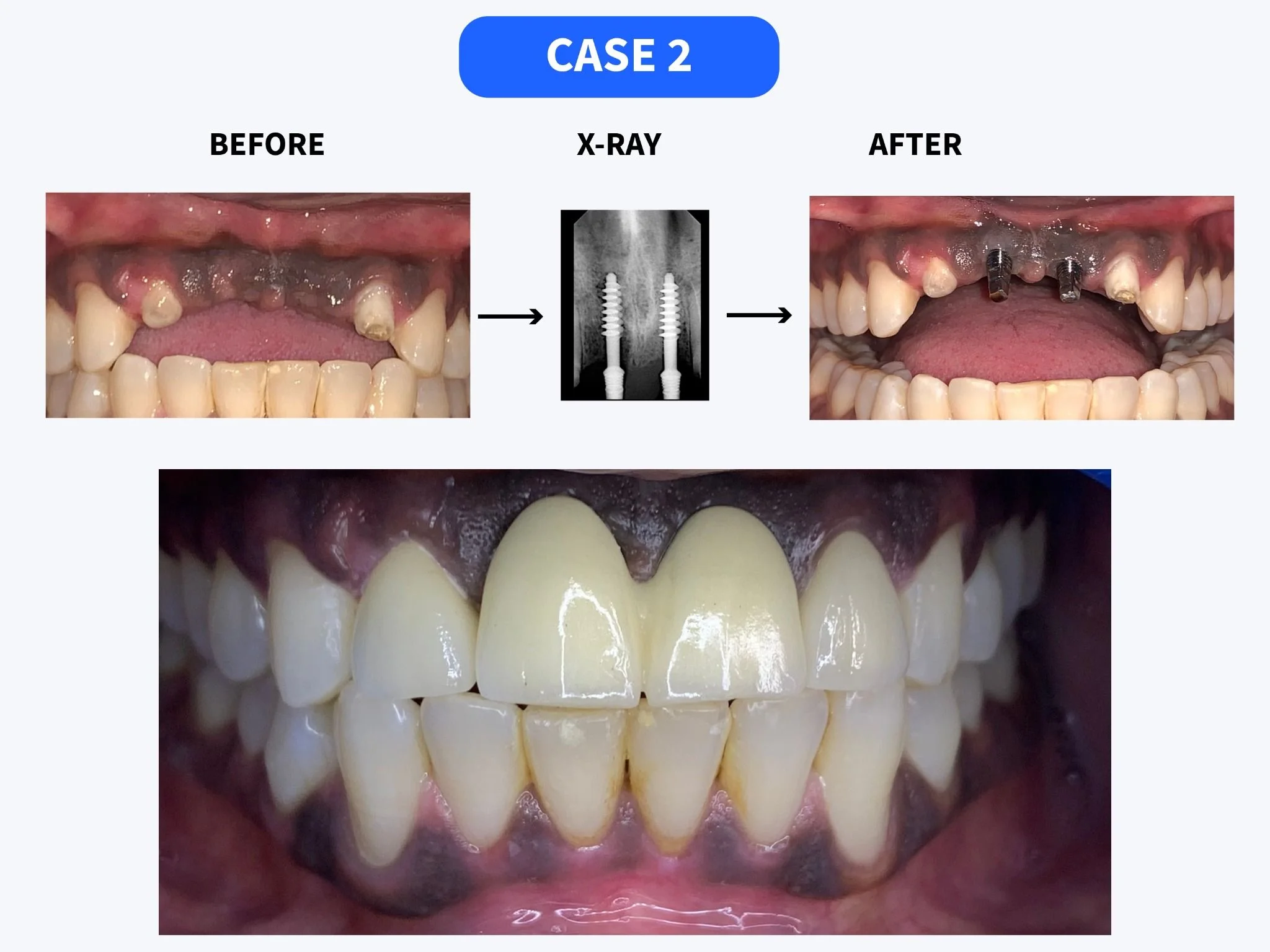 Dental implant smile restoration before and after at HSR Dental Booth