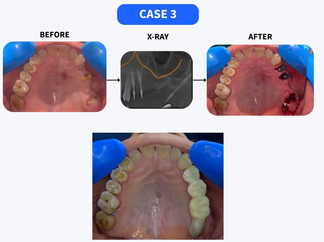 Dental implant before and after case 3 at HSR Dental Booth HSR Layout Bengaluru