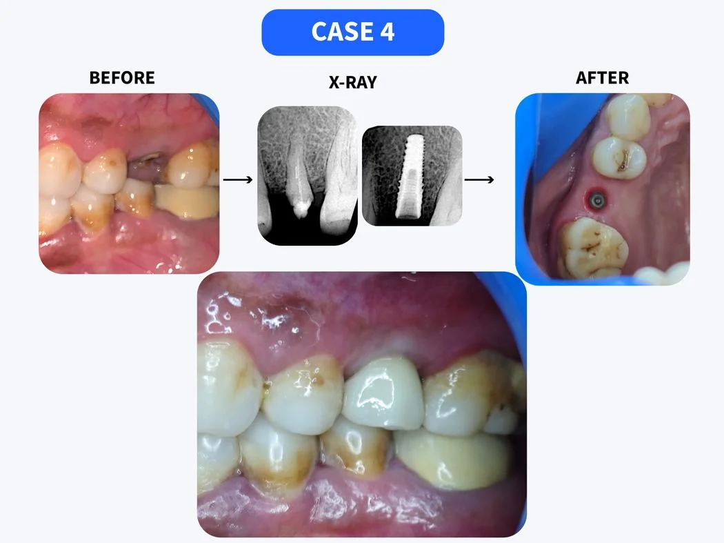 Dental implant before and after case 4 at HSR Dental Booth HSR Layout Bengaluru