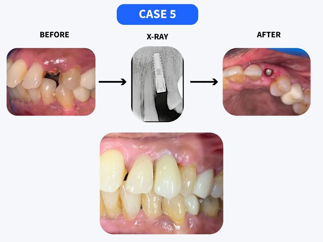 Dental implant before and after case 5 at HSR Dental Booth HSR Layout Bengaluru