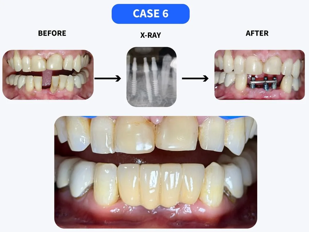 Dental implant before and after case 6 at HSR Dental Booth HSR Layout Bengaluru
