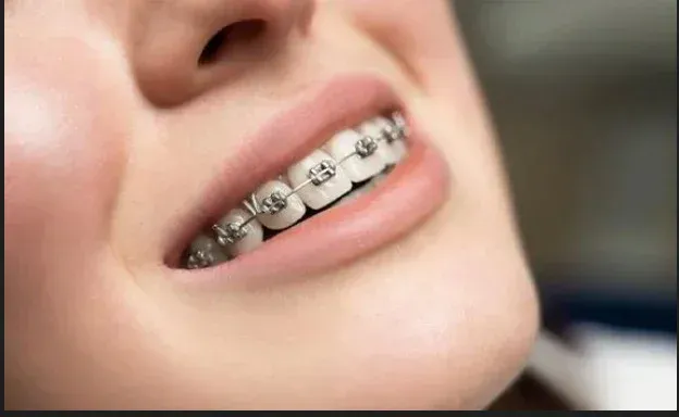 Metal and ceramic braces treatment at HSR Dental Booth, HSR Layout Bengaluru