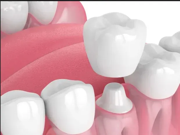 Dental crowns and caps restoration at HSR Dental Booth, HSR Layout Bengaluru