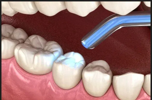 Tooth-coloured dental filling treatment at HSR Dental Booth, HSR Layout Bengaluru
