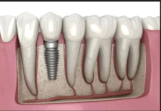 Dental implants and tooth replacement at HSR Dental Booth, HSR Layout Bengaluru
