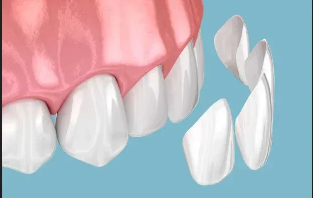 Porcelain and composite dental veneers at HSR Dental Booth, HSR Layout Bengaluru