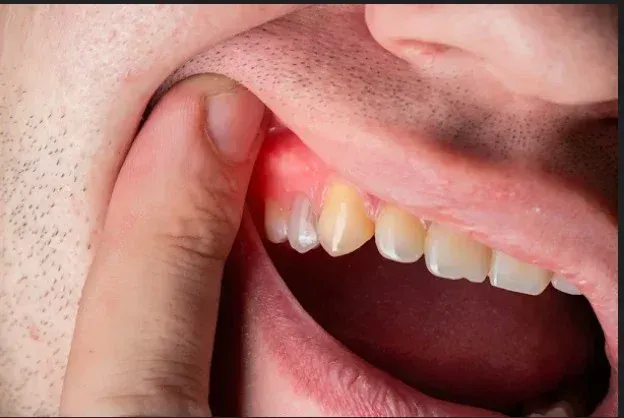 Emergency dental care for pain and swelling at HSR Dental Booth, HSR Layout Bengaluru