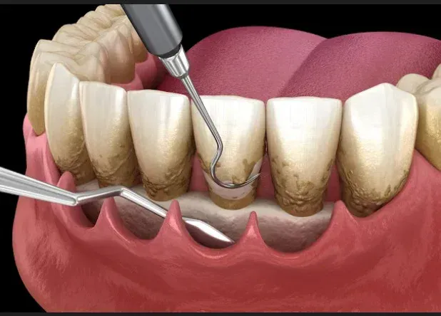 Gum treatment and deep cleaning at HSR Dental Booth, HSR Layout Bengaluru
