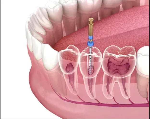 Painless root canal treatment at HSR Dental Booth, HSR Layout Bengaluru