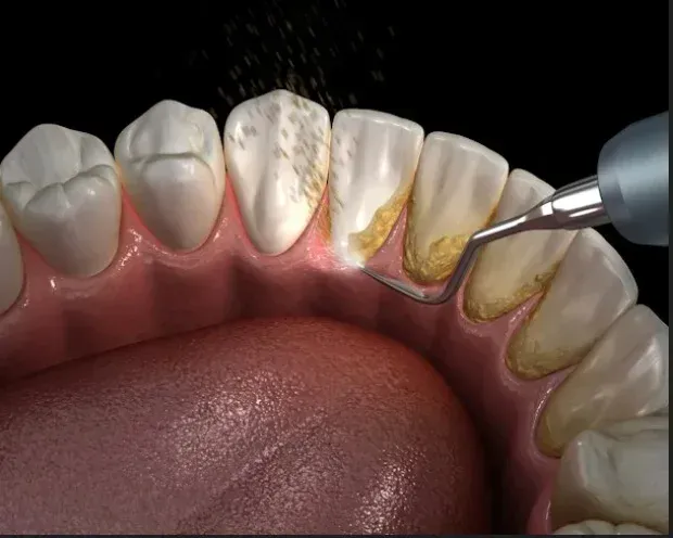 Professional teeth cleaning and scaling at HSR Dental Booth, HSR Layout Bengaluru