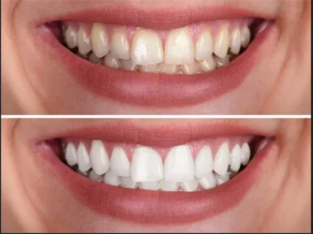 Teeth whitening and smile enhancement at HSR Dental Booth, HSR Layout Bengaluru