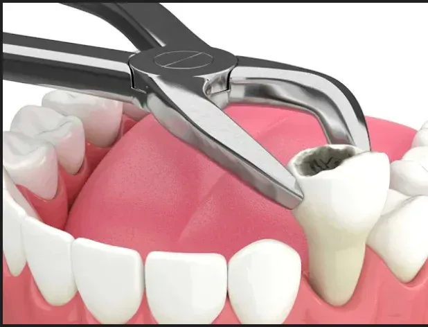 Tooth extraction and wisdom tooth removal at HSR Dental Booth, HSR Layout Bengaluru